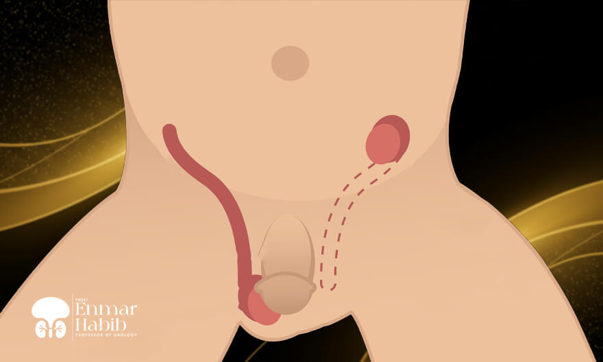 Treatment-of-Undescended-Testicle-and-Retractile-Testicle Treatment-of-Undescended-Testicle-and-Retractile-Testicle